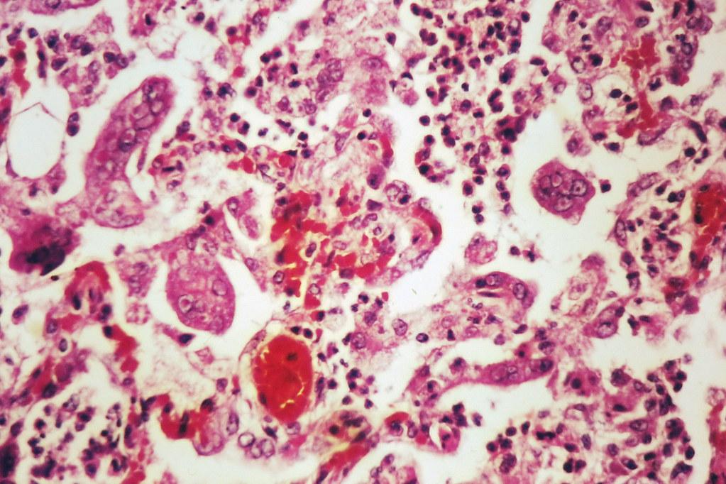 The Resurgence of the Vintage Virus - Measles Outbreaks Causing Concerns